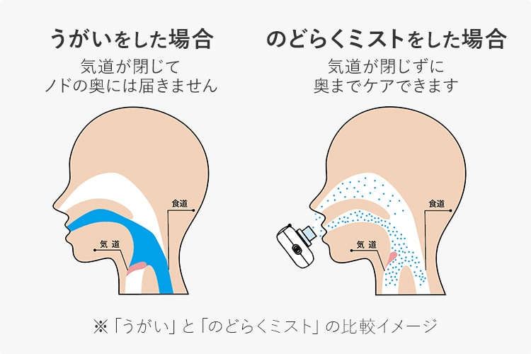 �������������ꍇ:�C�������ăm�h�̉��ɂ͓͂��܂��� �̂ǂ炭�~�X�g�������ꍇ:�C���������ɉ��܂ŃP�A�ł��܂� ���u�������v�Ɓu�̂ǂ炭�~�X�g�v�̔�r�C���[�W